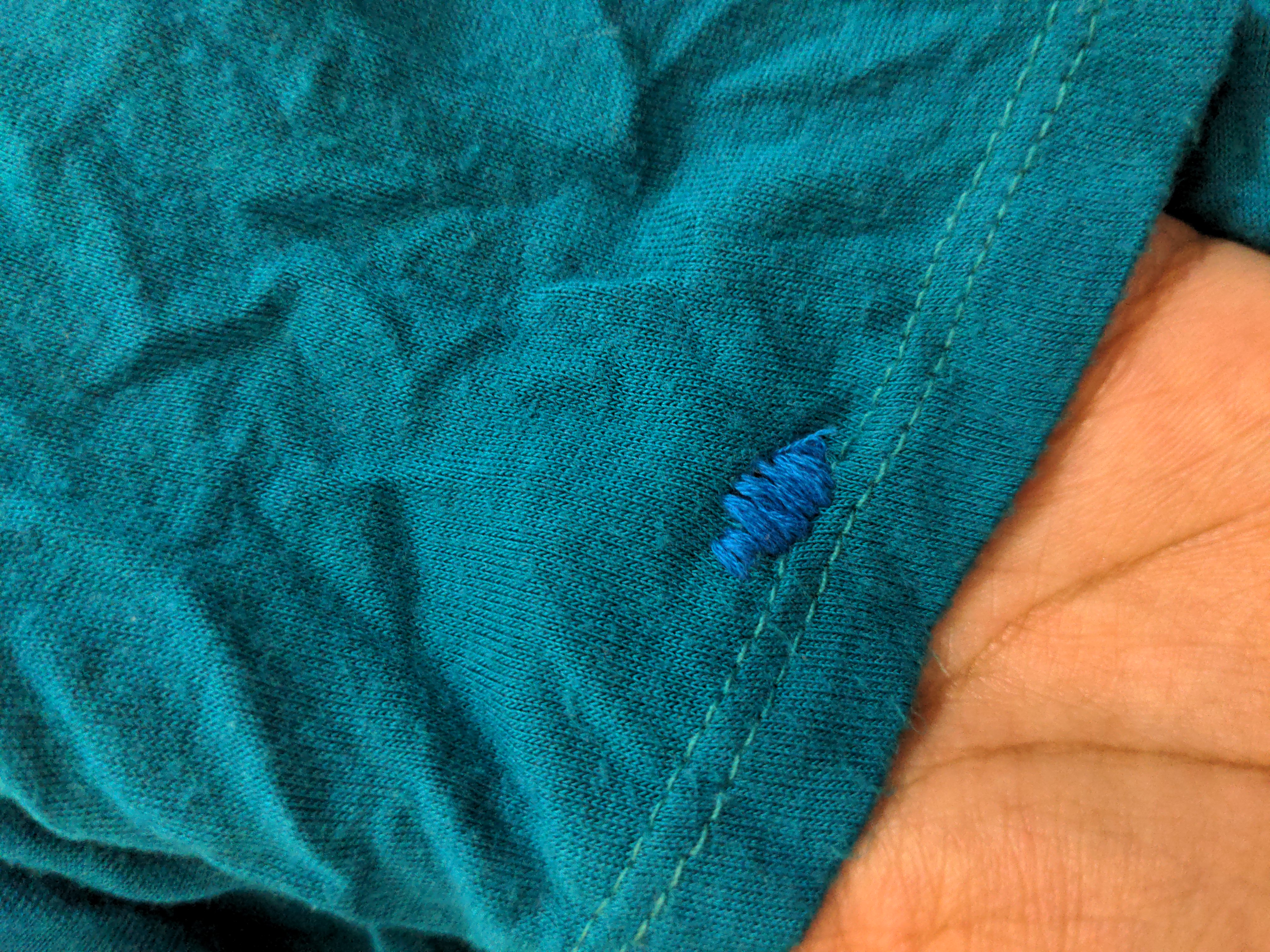 blue stitches cover the area where the pins were